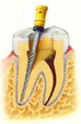 Endodoncia con microscopio